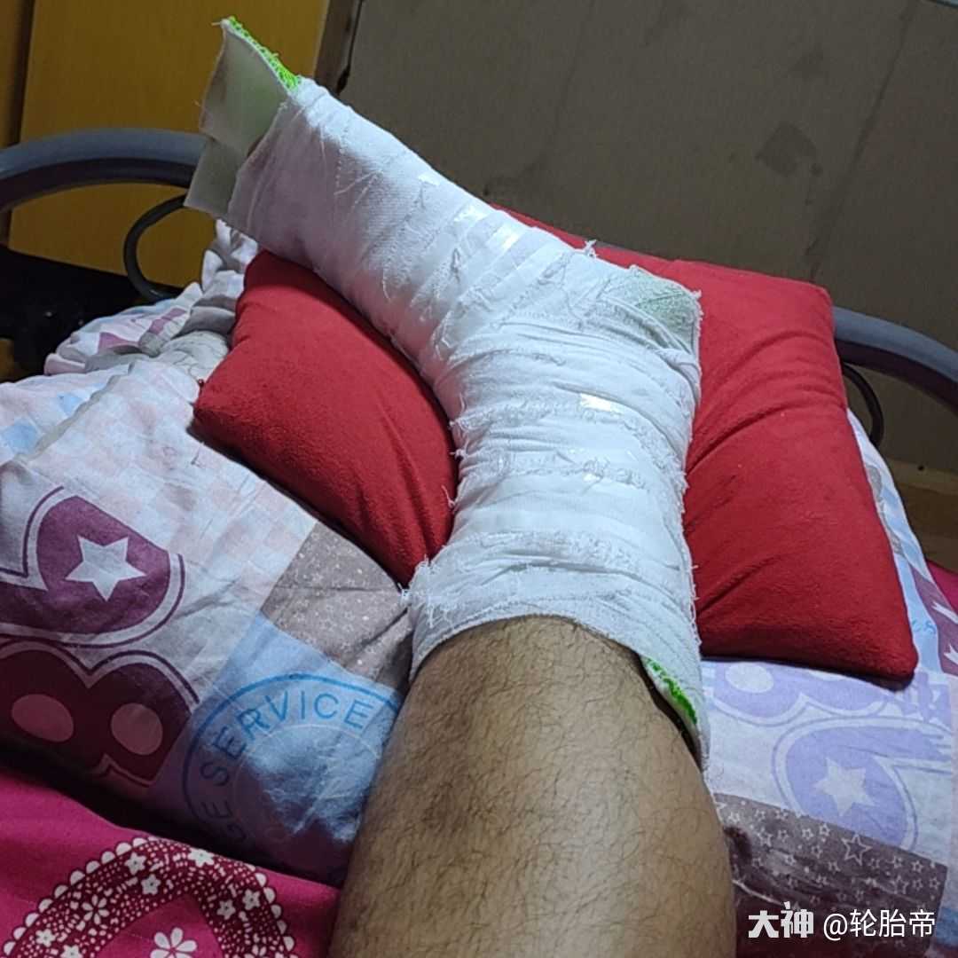 轮胎帝:骨折了,这能躺床上玩大话.小伙伴们能不能给点祝福